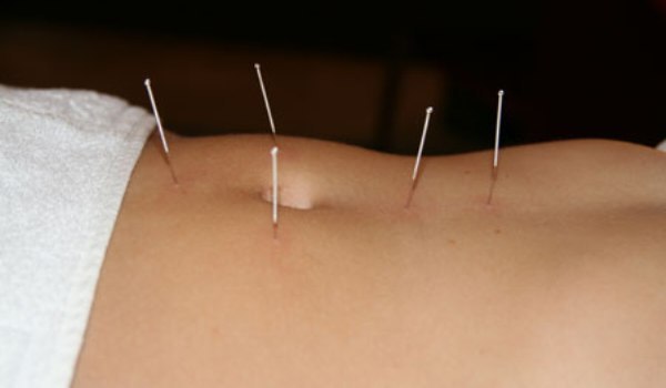 acupunctura