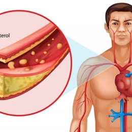 Ce este COLESTEROLUL? CARE SUNT VALORILE NORMALE ŞI DE RISC ALE COLESTEROLULUI