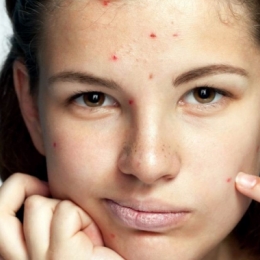 Cum să scapi de acnee definitiv. Sfaturi de la specialist