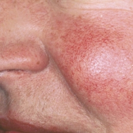 Cum se manifestă acneea rozacee