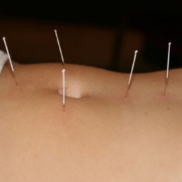 Boli tratate prin acupunctură