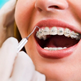 Ghidul pacientului pentru îngrijirea aparatelor dentare. Sfaturi utile de la Dr. Nicoleta Lucaci