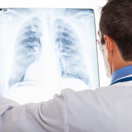 Majoritatea cazurilor de cancer pulmonar, diagnosticate târziu