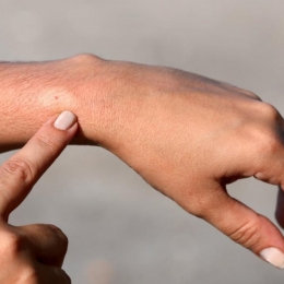 Primul ajutor. Ce faci dacă te-a înţepat o albină