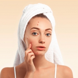 Sfaturi pentru a evita formarea cicatricilor post-acnee