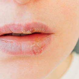 Cum tratezi herpesul natural
