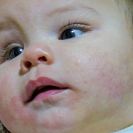 Dermatita atopică apare cel mai des la copii
