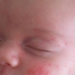 Eritemul alergic la nou-născut: de ce apare şi cum se vindecă