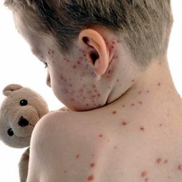 Focar de varicelă la Constanţa! Copiii de grădiniţă, cei mai expuşi