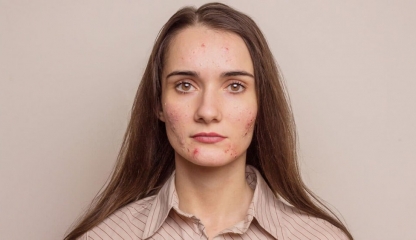 Acneea la adolescenți: de ce tratamentele găsite pe rețelele sociale pot fi periculoase