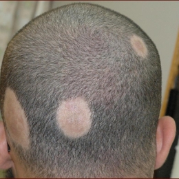 Cum poate fi stopată căderea părului. "Nu există un tratament standard pentru alopecie"