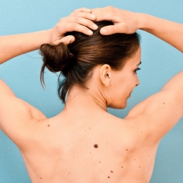 Când sunt aluniţele de pe corp periculoase. Ce spune specialistul