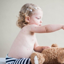 Virusul coxsackie poate afecta atât copiii, cât şi adulţii