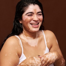 Nu vă speriaţi! Vitiligo nu este o boală contagioasă
