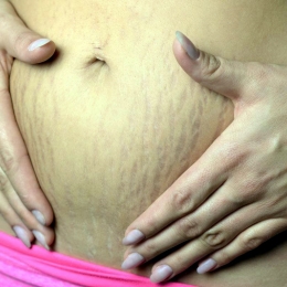 Metoda de refacere a abdomenului, indicată după naştere sau slăbit