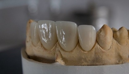 Tipuri de proteze dentare și prețurile unei proteze – Ce alegi și de ce contează