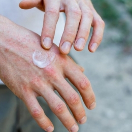 Psoriazisul apare și din cauza stresului sau a alcoolului în exces