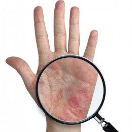 Stresul agravează simptomele psoriazisului şi creşte riscul de recidivă