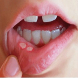 Aftele bucale - cauze, tratament, prevenire