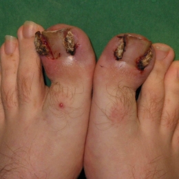 Ce-i de făcut dacă aveţi unghii încarnate