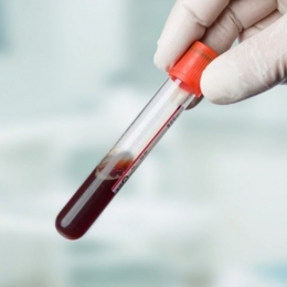 Urinarea cu sânge este produsă de diferite infecţii sau inflamaţii