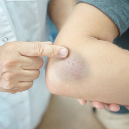 Cum scăpaţi în doi timp şi trei mişcări de vânătăi