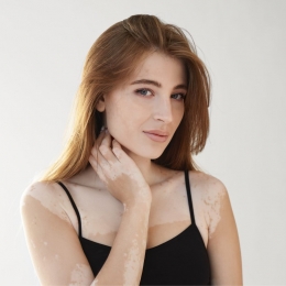 Vitiligo, boala care duce la pierderea pigmentului şi decolorarea pielii