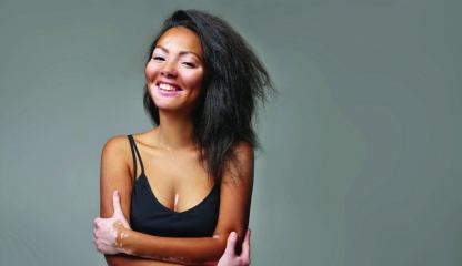 Suferiți de vitiligo? Mare atenție cu expunerea la soare!