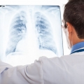 Majoritatea cazurilor de cancer pulmonar, diagnosticate târziu