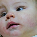 Dermatita atopică apare cel mai des la copii