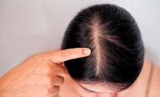Aveți coji pe scalp? Iată ce poate însemna acest lucru