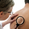 Care sunt principalii factori ce pot cauza cancer de piele