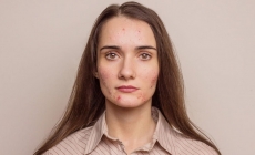 Acneea la adolescenți: de ce tratamentele găsite pe rețelele sociale pot fi periculoase