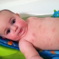 Infecţii ale pielii bebeluşului. Cum se tratează fiecare afecţiune în parte