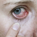 Infecţiile oculare necesită tratamente de lungă durată