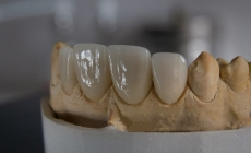 Tipuri de proteze dentare și prețurile unei proteze – Ce alegi și de ce contează