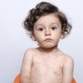 Rujeola poate provoca infecții ale urechii şi chiar convulsii