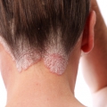 Consultul periodic la dermatolog, esenţial pentru bolnavii de psoriazis