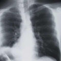 Cum poţi depista cancerul pulmonar în fază incipientă