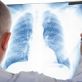 Tuberculoza - cum se manifestă şi cum se răspândeşte boala