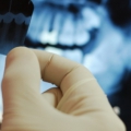 Cum ne pot îmbolnăvi de cancer radiografiile dentare